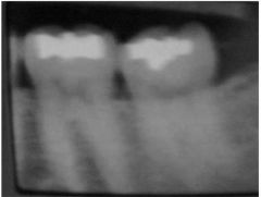 Motion during a radiograph results in a ______ image