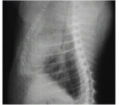 Other common artifacts:


Will appear as streaky straight lines on a radiograph