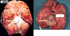 Meningitis
- Thick white exudate overlying the pons
- On the rest of the brain you can see how the meninges should look (clear)
- Some have a predilection for the base of the brain