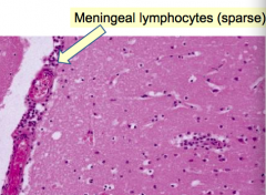 - Usually viral (arboviruses, enteroviruses - echovirus and coxsackie)
- Much less fulminant than bacterial meningitis
- Less severe symptoms
- More common in summer and early fall
- Lymphocytic infiltrate in meninges