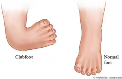 Scientific name of club foot
