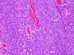 The WHO grade that best fits the image seen here from a dural based meningioma in a 10-year-old girl would be which of the following?
WHO grades I - V
