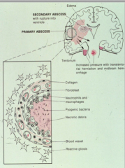 Brain abscesses - circumscribed focus of infection
- Fibroblastic response leads to a capsule wall
- Inside contains the pathogen 
- Outside contains reactive astrocytes