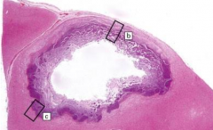 - Center is necrotic
- Edges contain inflammatory cells and fibrous capsule
- Presence of giant cells (in non-bacterial infections)