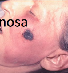 1.  Vesicle--> hemorrhagic pustule--> necrotic ulcer
2.  Must assume pseudomonas sepsis