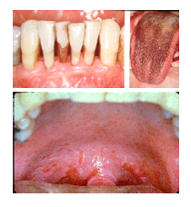 Increased Calculus accumulation 
Altered taste sensation 
Staining (enamel, root, tongue and composite
May cause mucosal ulceration
