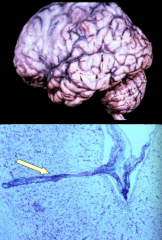 - Meningoencephalitis: thickened meninges (see cloudiness) and atrophic brain
- Meninges and parenchyma contain lymphocytes, plasma cells, and microglia in the perivascular space (can then spread into the parenchyma)

- Gradual impairment of co...