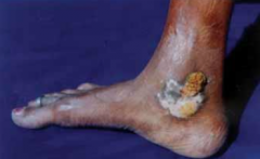 1.  Exogenous inoculation---- Prosector's wart
2.  Usually on doors of hands and fingers, buttocks, and ankles