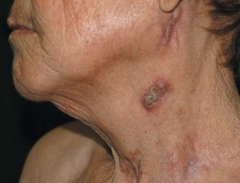 1.  Direct extension to skin from underlying tuberculous lymphadenitis
2.  Occurs over cervical lymph node,s bone, and joints