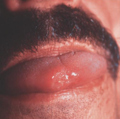 1.  Occurs at mucocutaneous borders of nose, mouth, tongue, anus, urinary meatus, and vagina
2.  Autoinoculation from underlying active TB
3.  Non-healing ulcer
