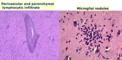 - Perivascular and parenchymal lymphocytic infiltrate
- Microglial nodules
- Neuronophagia