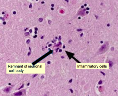 Neuronophagia - sign of VIRAL (meningo)encephalitis