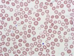 The blood smear pictured shows a dimorphic red cell population. This can be seen in
A) myelodysplastic syndrome (MDS). 
B) oxidative hemolysis. 
C) hereditary spherocytosis (HS). 
D) hereditary elliptocytosis (HE). 
E) thrombotic thrombocytop...