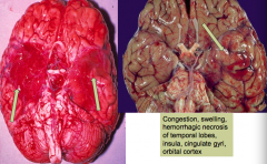 - Congestion and swelling
- Hemorrhagic necrosis of temporal lobes, insula, cingulate gyri, and orbital cortex