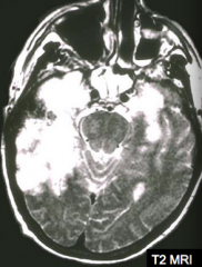 If your patient has this MRI and presents with mood, memory, and behavioral abnormalities, what should you consider? How should you confirm this diagnosis?