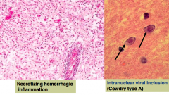 - Necrotizing hemorrhagic inflammation
- Intranuclear viral inclusions (Cowdry type A)