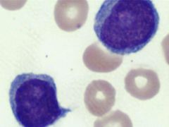 An 88-year-old man presents to the emergency room with a WBC of 110,000 (Reference Range: 4,000-10,000) and extreme fatigue.  The emergency room physician asks you to review the peripheral blood smear where you see the following cells, comprising ...