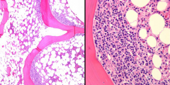 An 82-year-old man is diagnosed with diffuse large B-cell lymphoma (DLBCL) of the lung, and representative images from a staging bone marrow biopsy are shown.  Which one of the following statements is correct regarding this histological pattern of...