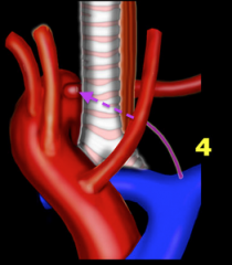 Two most common types of complete vascular rings (85–95%)
o Double aortic arch
o Right aortic arch with left ligamentum arteriosum