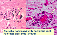HIV encephalitis / leukoencephalopathy:
- Microglial nodules with HIV-containing multi-nucleated giant cells (arrows)