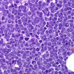 79-year-old man is being evaluated for extensive lymphadenopathy and an elevated WBC count of 100,804/µL (Reference Range: 4,000-10,000/µL), with 79% atypical cells.  A representative image of the bone marrow core biopsy is shown.  Flow cytometr...