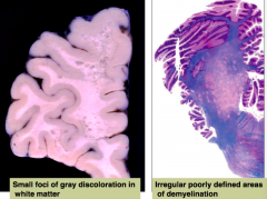 - Small foci of gray discoloration in white matter (leuko - white matter)
- Irregular, poorly defined areas of demyelination