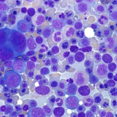 A 29-year-old man with history of acute promyelocytic leukemia has a bone marrow biopsy performed for pancytopenia, 45 days after induction chemotherapy; he is currently on maintenance chemotherapy with arsenic trioxide and idarubicin.  A represen...