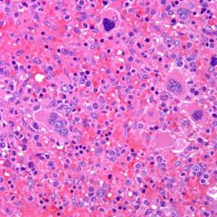 An 82-year-old woman has a splenectomy performed for splenomegaly (3,000 g spleen weight).  A representative microphotograph is shown.  What is the most likely diagnosis made in a bone marrow biopsy performed concomitantly?
A) Hepatosplenic T-cel...