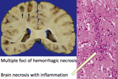 - Multiple foci of hemorrhagic necrosis
- Brain necrosis with inflammation