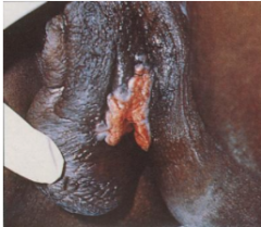 1.  Esthiomene: pseudo elephantiasis of genitals