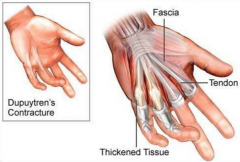 Contraction of palmar fascia so that fingers (mostly little and ring fingers) cannot contract