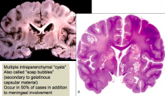 - Meningitis with or without brain parenchymal cysts (encephalitis)
- Abscesses (Cryptococcomas)