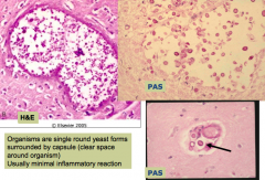 - Organisms are single round yeast forms surrounded by a capsule (clear space around organism = bottom right picture)
- Usually minimal inflammatory reaction