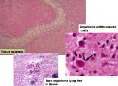 - Tissue necrosis
- Toxo organisms can be found within pseudocysts or lie free in tissue