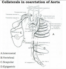 Coarctation

Turner's syndrome (20%)
Berry aneurysms 5-10%
Hypertension
Bicuspid valve 75%
VSD