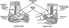 Pain in the midfoot zone and any one of the following
A) Bone tenderness over base of 5th metatarsal 
B) Bone tenderness over navicular
C) Inability to bear weight both immediately and in the emergency department for four steps
