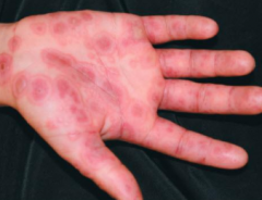 1.  Herpetic lesions on hand