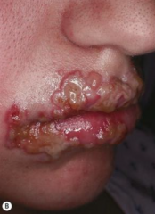 1.  Fever blister/cold sore
2.  Grouped vesicles on erythematous base
3.  MC on lips