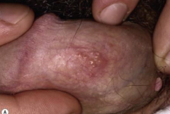 1.  Genital herpes
2.  Pustules, ulceration
3.  Painful