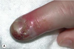 1.  Infection of hand with vesicular lesions--- distal phalanx 
2.  MCC: HSV-2