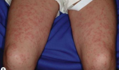 1.  Abrupt onset of skin colored to pink-red papule on cheeks, buttocks, and extremities
2.  Non-pruritic
3.  Low-grade fever