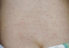 1.  High fever
2.  Followed by rash
3.  Discrete circular, red rose macules surrounded by white halo
4.  Febrile seizures