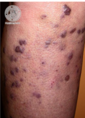 1.  Symmetrical widespread lesion
2.  Mucocutaneous surfaces may be involved
3.  B-cell lymphoma