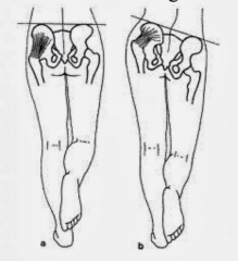 Trendelenburg's sign
Left leg is affected

Caused by weak left abductors that normally keeps the hip straight.