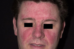Seborrheic Dermatitis (1)