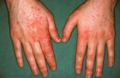 Contact Dermatitis