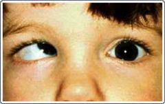 Function: abducts the eye via nerve supply to LATERAL RECTUS MM


Damage: diplopia, convergent squint (MEDIAL STRABISMUS), abductor paralysis of IPSILATERAL  eye