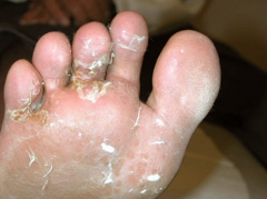 Dermatophytoses: Tinea Pedis (Athlete's Foot)