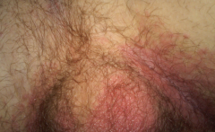 Dermatophytoses: Tinea Cruris (Jock Itch)
