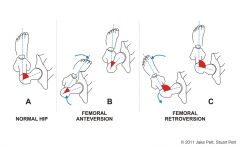 femoral neck rotated forward relative to femoral condyles (can lead to toe-in)